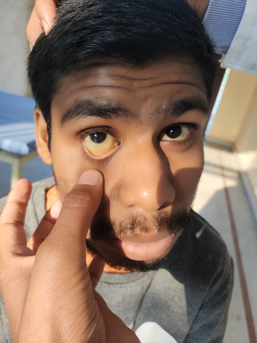 After Jaundice Treatment